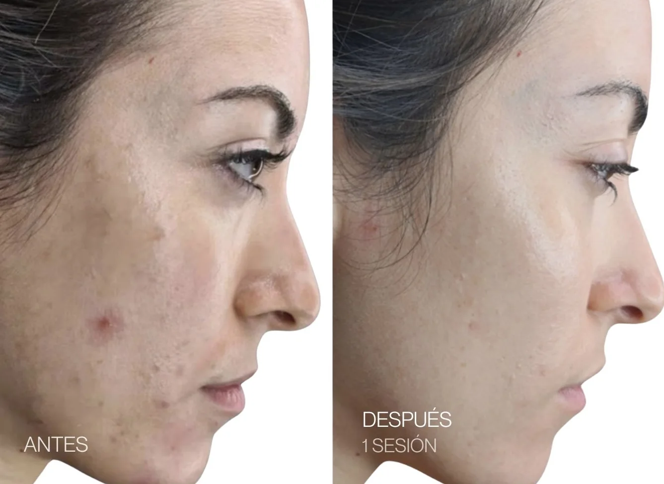 Antes y después de 1 sesión de REGEN facial