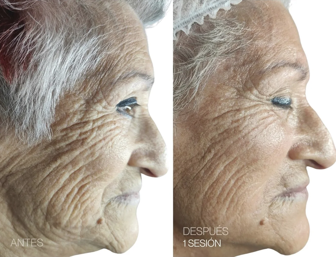 Antes y después de 1 sesión de REGEN facial