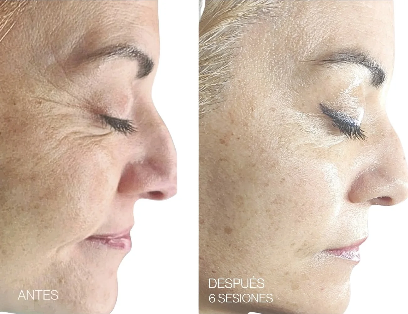 Antes y después de 6 sesiones de REGEN facial