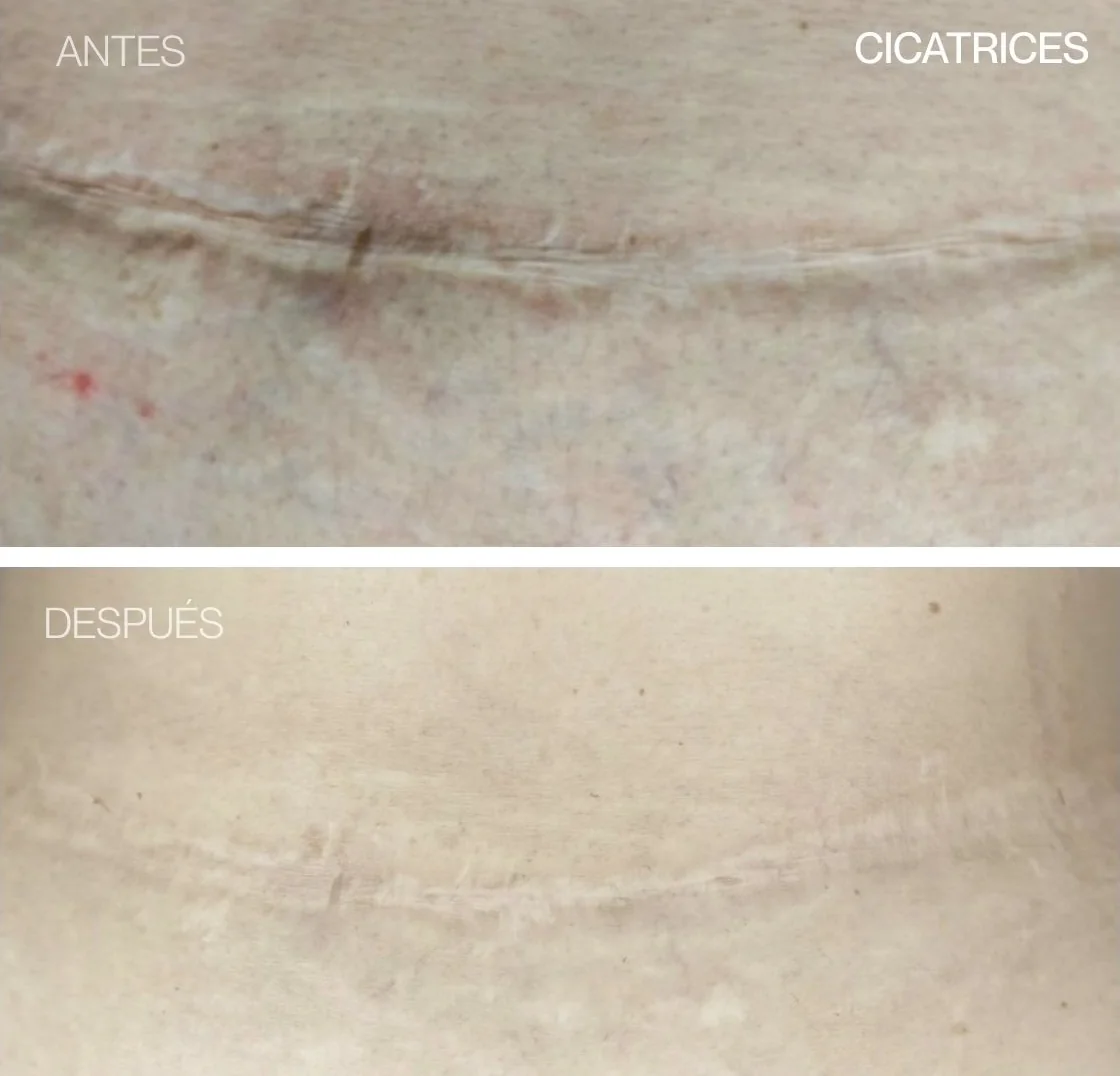 Antes y después de REGEN en una cicatriz, clienta de Luhdeline