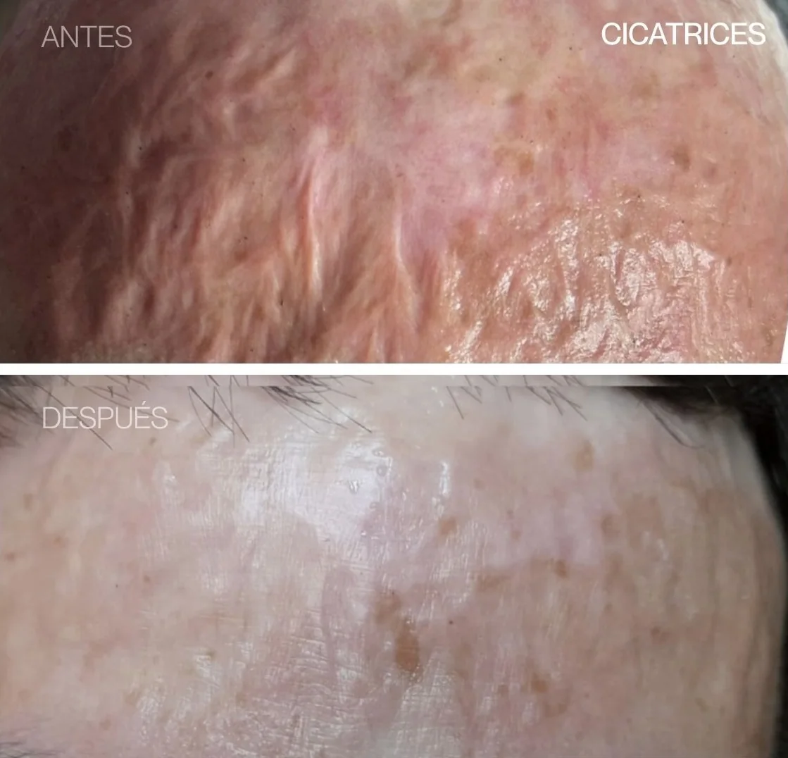Antes y después de REGEN en una cicatriz