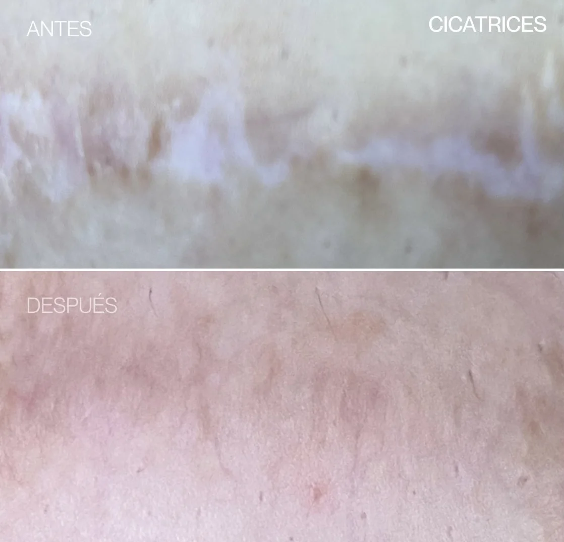 Antes y después de REGEN en una cicatriz
