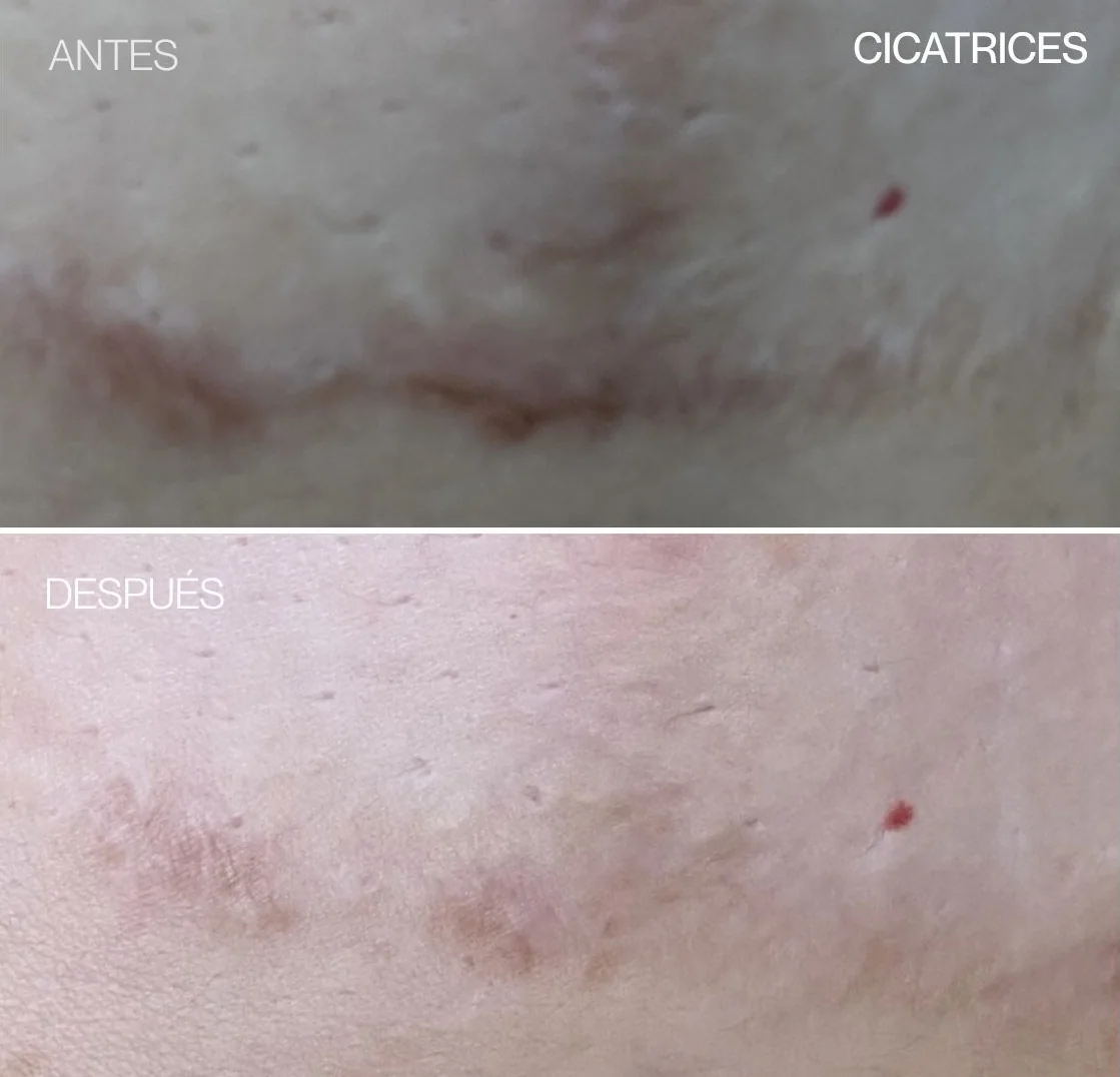 Antes y después de REGEN en una cicatriz