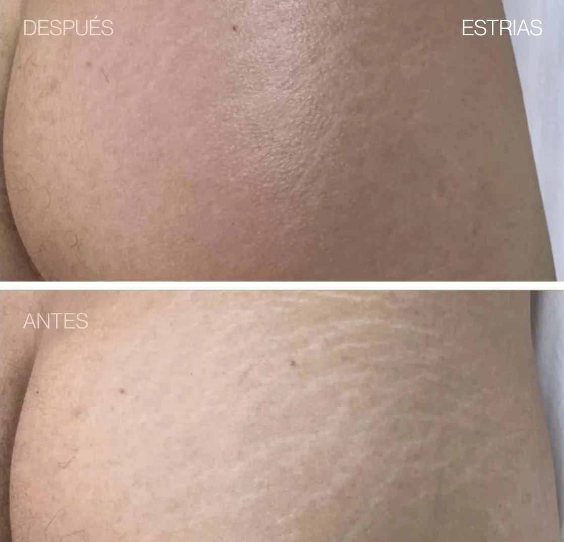 Antes y después de REGEN en estrías, clienta de Luhdeline