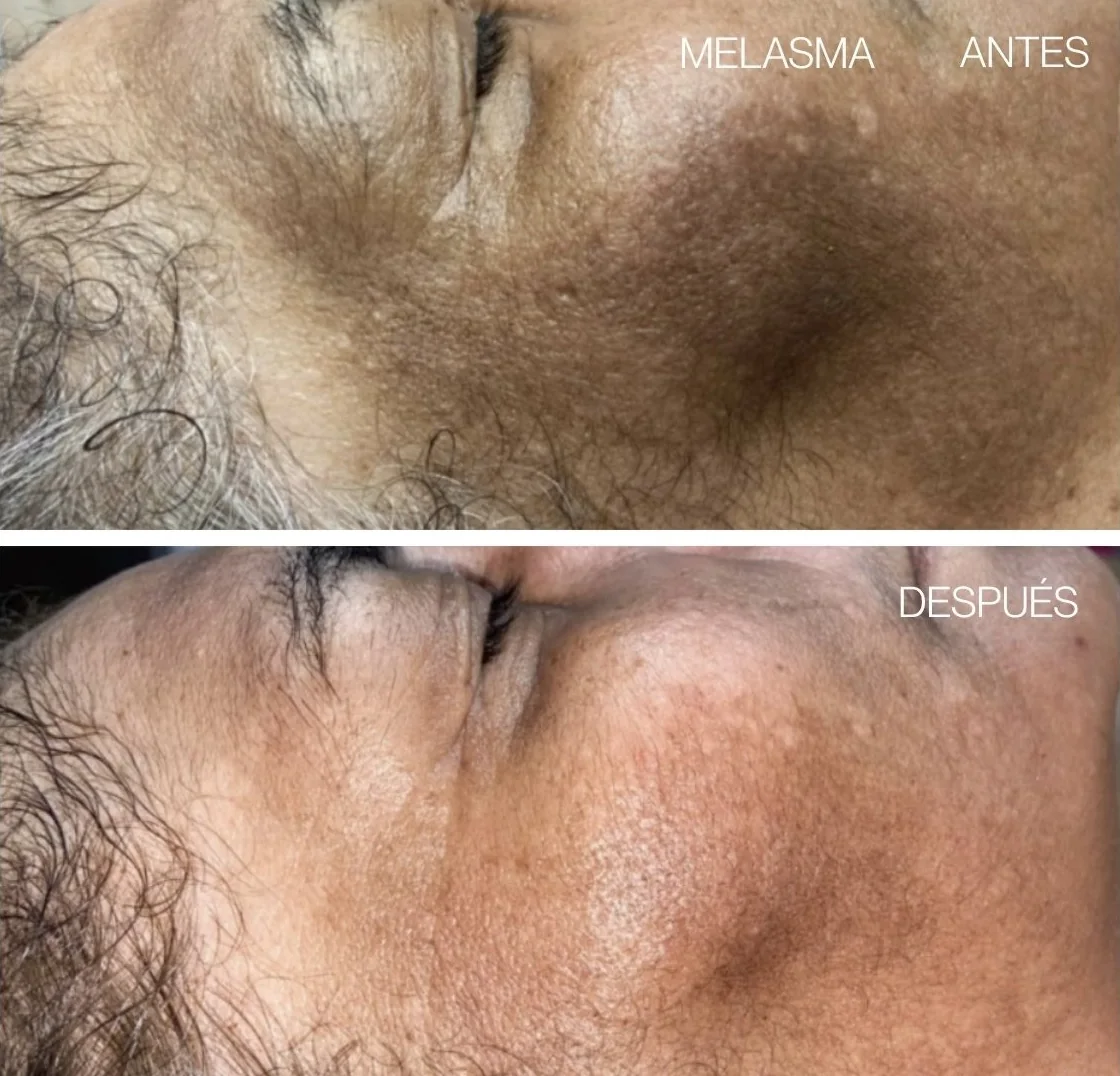 Antes y después de REGEN en melasma