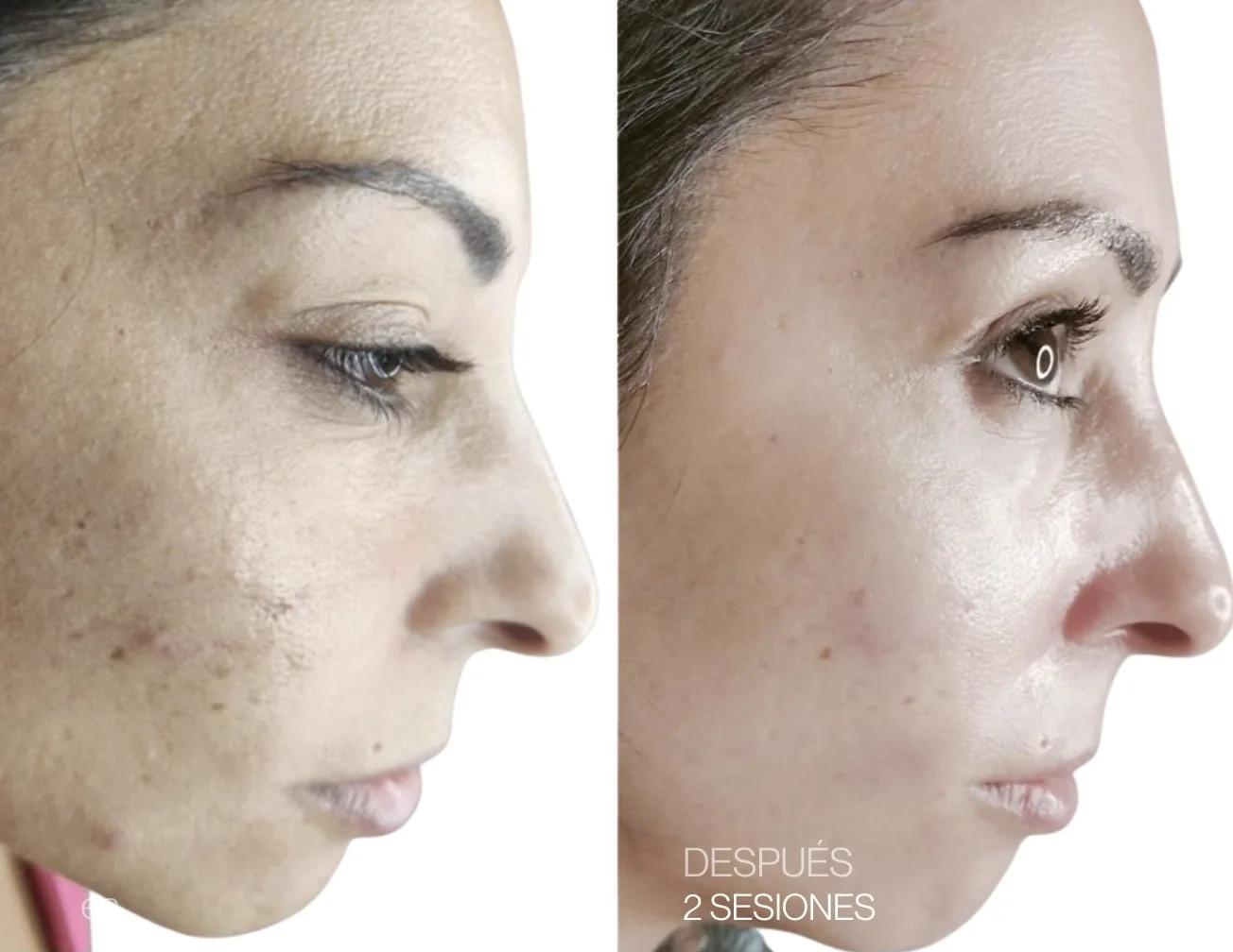 Antes y después de 2 sesiones de REGEN facial
