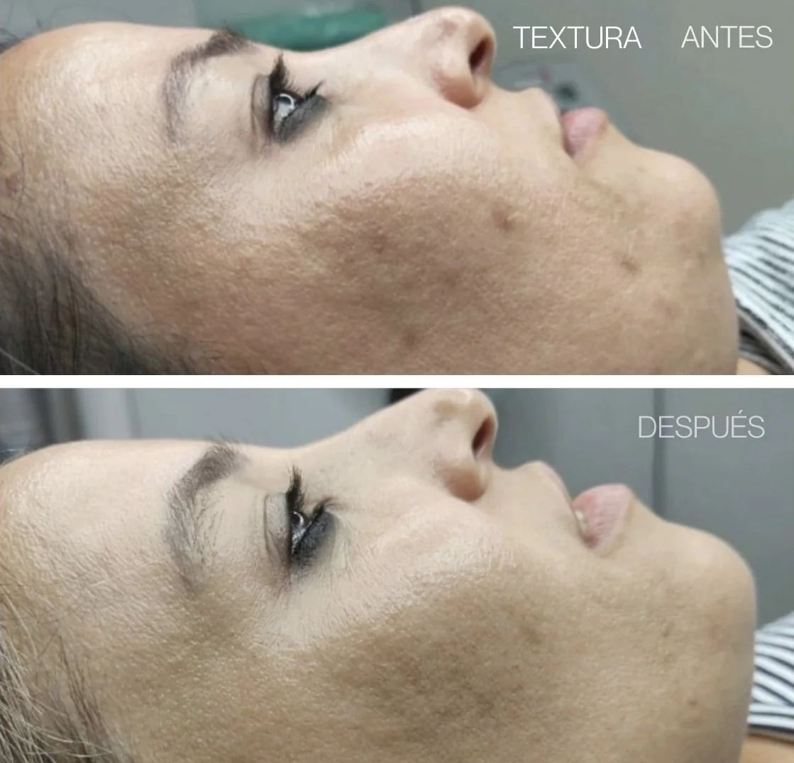 Antes y después de REGEN en la textura de la piel del rostro